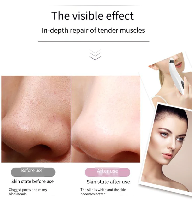 Before and after nose comparison showing visible pore improvement using blackhead remover vacuum for smoother, clearer skin.