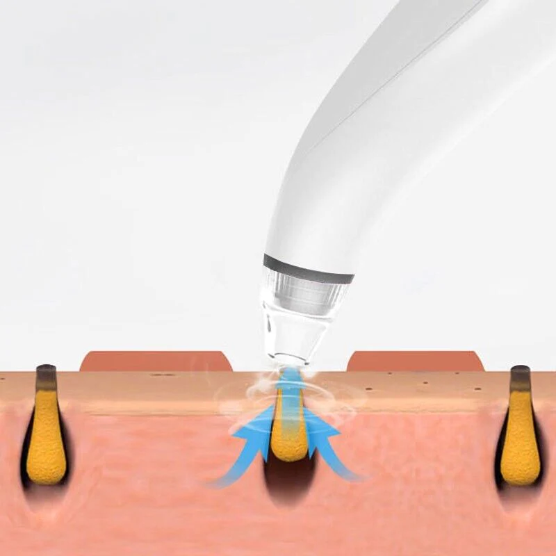 Conceptual illustration of blackhead vacuum device extracting impurities from pores and hair follicles for deep skin cleansing.