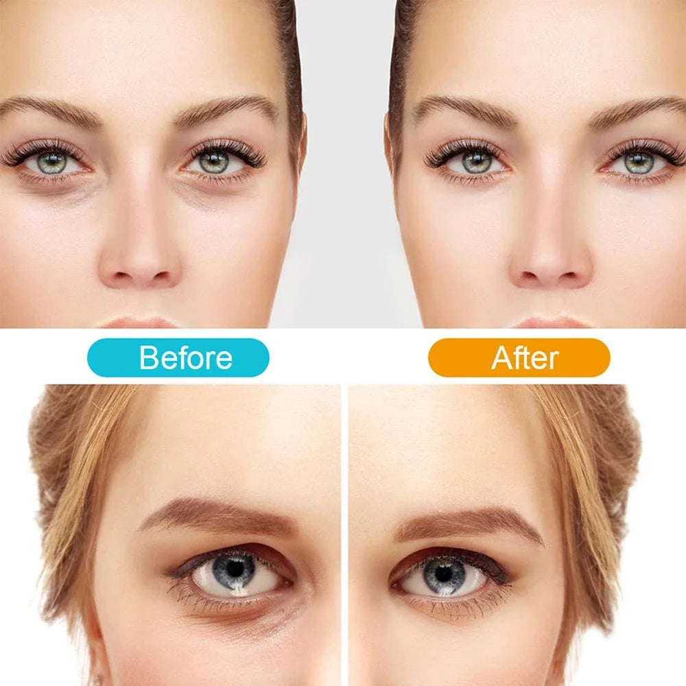 Before and after results of using 3D EMS red light eye massager showing visible reduction in eye bags, puffiness, and dark circles