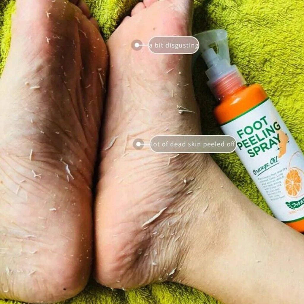 Foot peeling spray results showing exfoliation and dead skin removal using orange oil formula for smoother feet