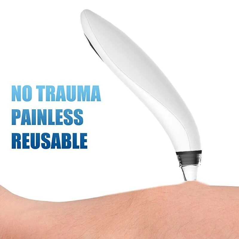 White handheld blackhead remover vacuum offering painless, non-traumatic pore cleansing with reusable design for gentle skin care.